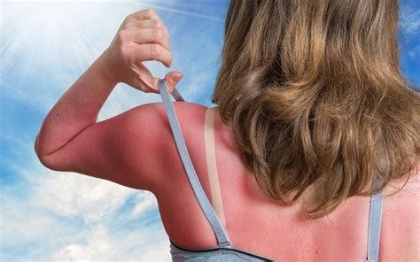 why is my sunburn leaking yellow|Sunburn: Symptoms & Treatment